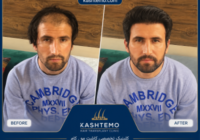 نمونه کار قبل و بعد آقای فخاری | کلینیک تخصصی کاشت مو