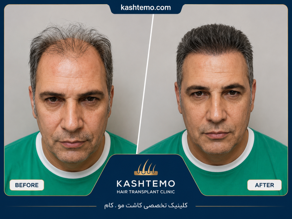نمونه کار قبل و بعد کاشت مو آقای یوسفی