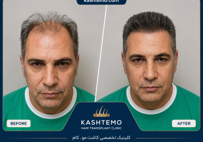 نمونه کار قبل و بعد کاشت مو آقای یوسفی