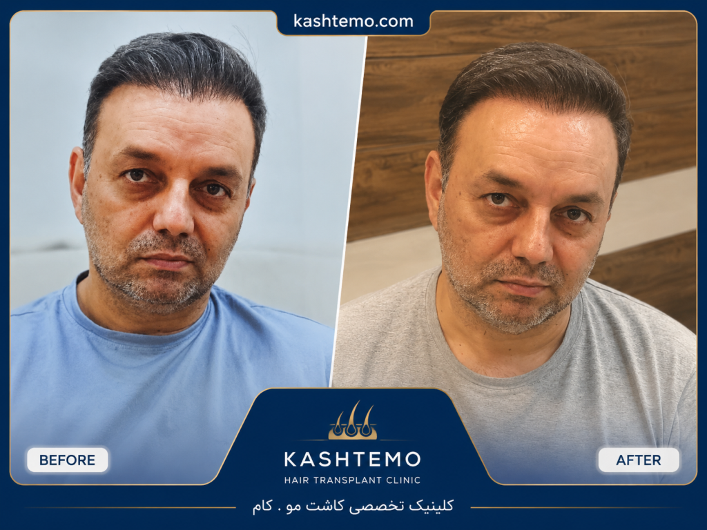 نمونه کار قبل و بعد کاشت مو آقای محمدی