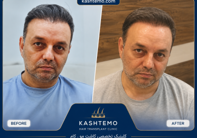 نمونه کار قبل و بعد کاشت مو آقای محمدی