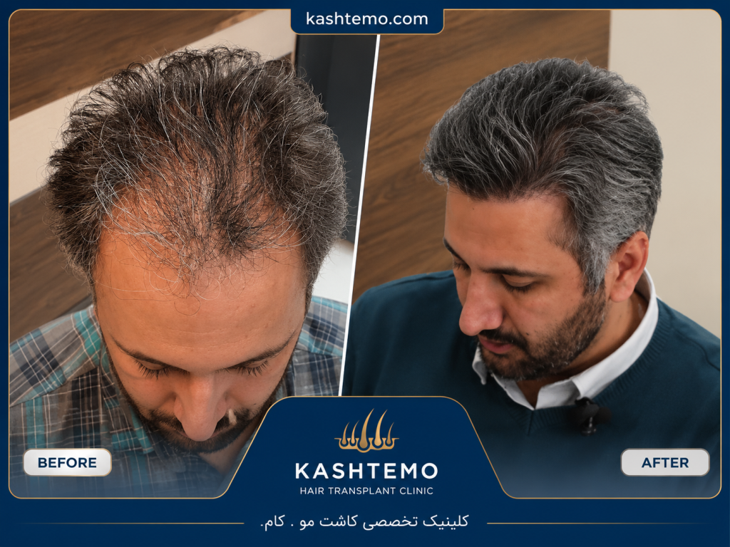نمونه کار قبل و بعد کاشت مو آقای محسنی