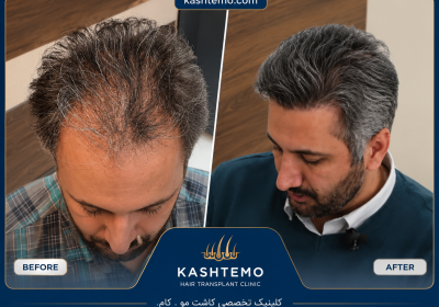 نمونه کار قبل و بعد کاشت مو آقای محسنی
