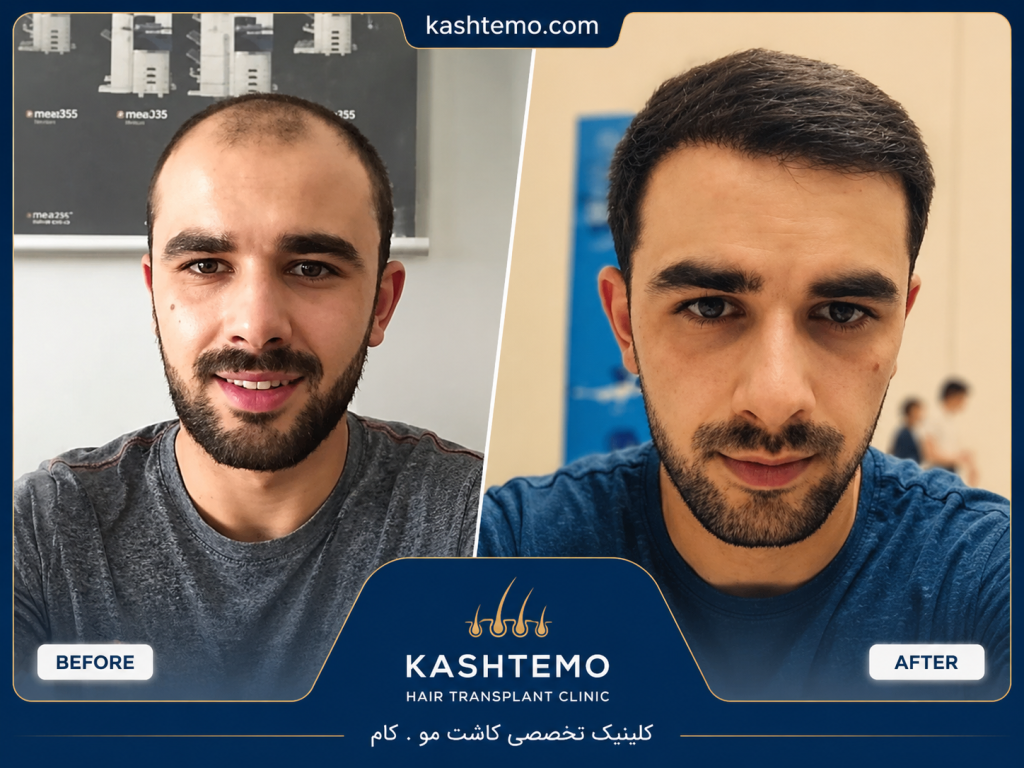 نمونه کار قبل و بعد کاشت مو آقای کرمی