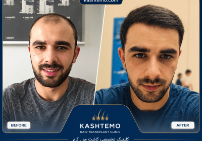 نمونه کار قبل و بعد کاشت مو آقای کرمی