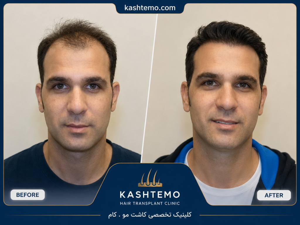نمونه کار قبل و بعد کاشت مو آقای میرزایی