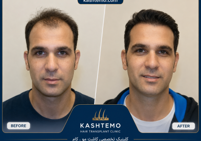 نمونه کار قبل و بعد کاشت مو آقای میرزایی