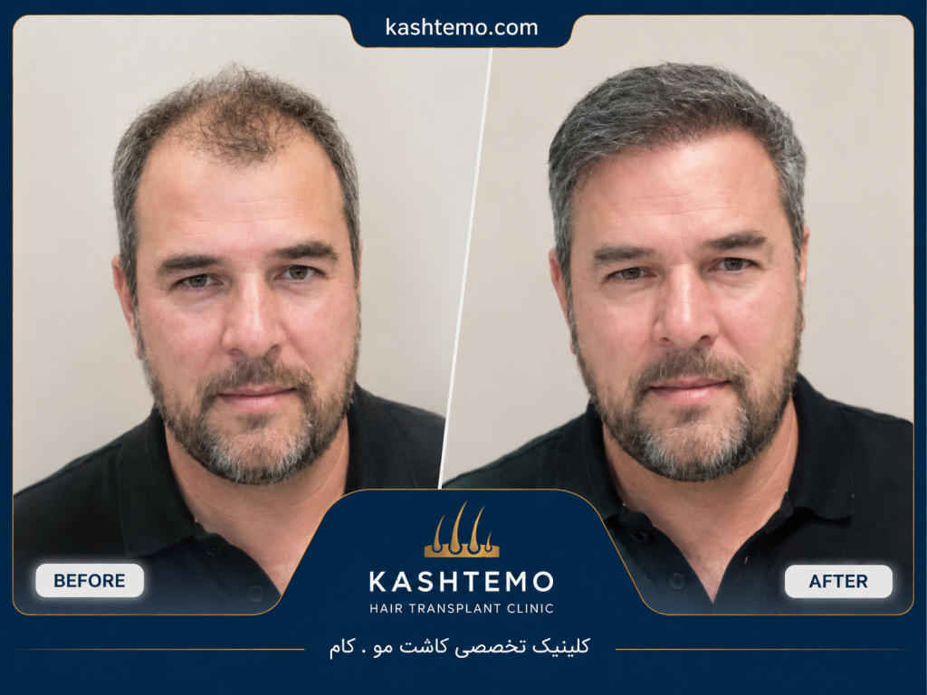 نمونه کار قبل و بعد کاشت مو آقای موسوی