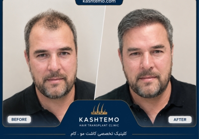 نمونه کار قبل و بعد کاشت مو آقای موسوی