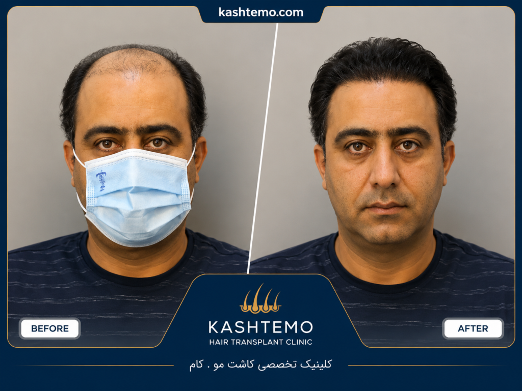 نمونه کار قبل و بعد کاشت مو آقای کشاورز