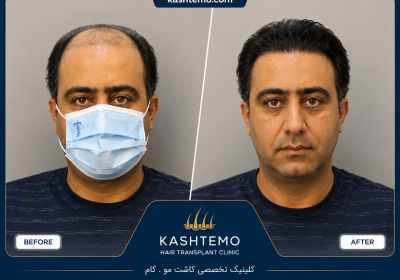 نمونه کار قبل و بعد کاشت مو آقای کشاورز
