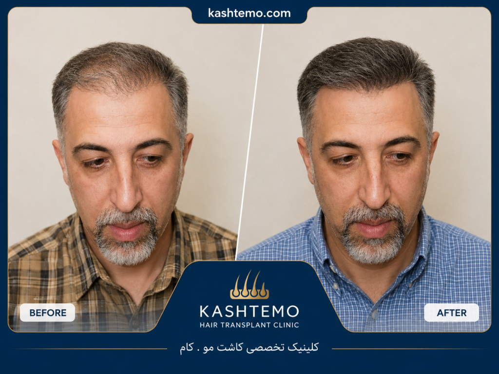 نمونه کار قبل و بعد کاشت مو آقای کاظمی