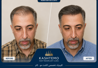 نمونه کار قبل و بعد کاشت مو آقای کاظمی
