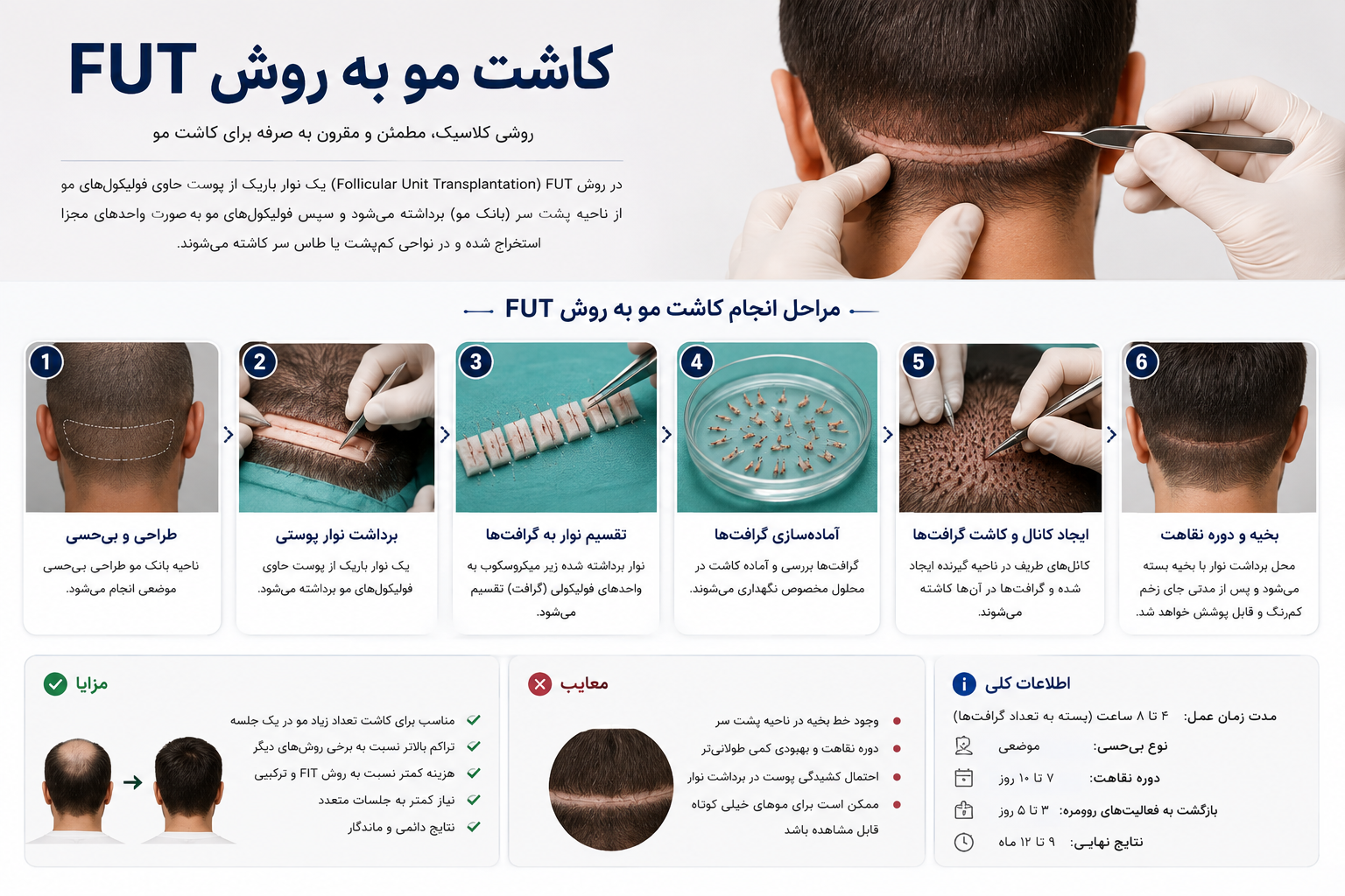 کاشت مو به روش FUT