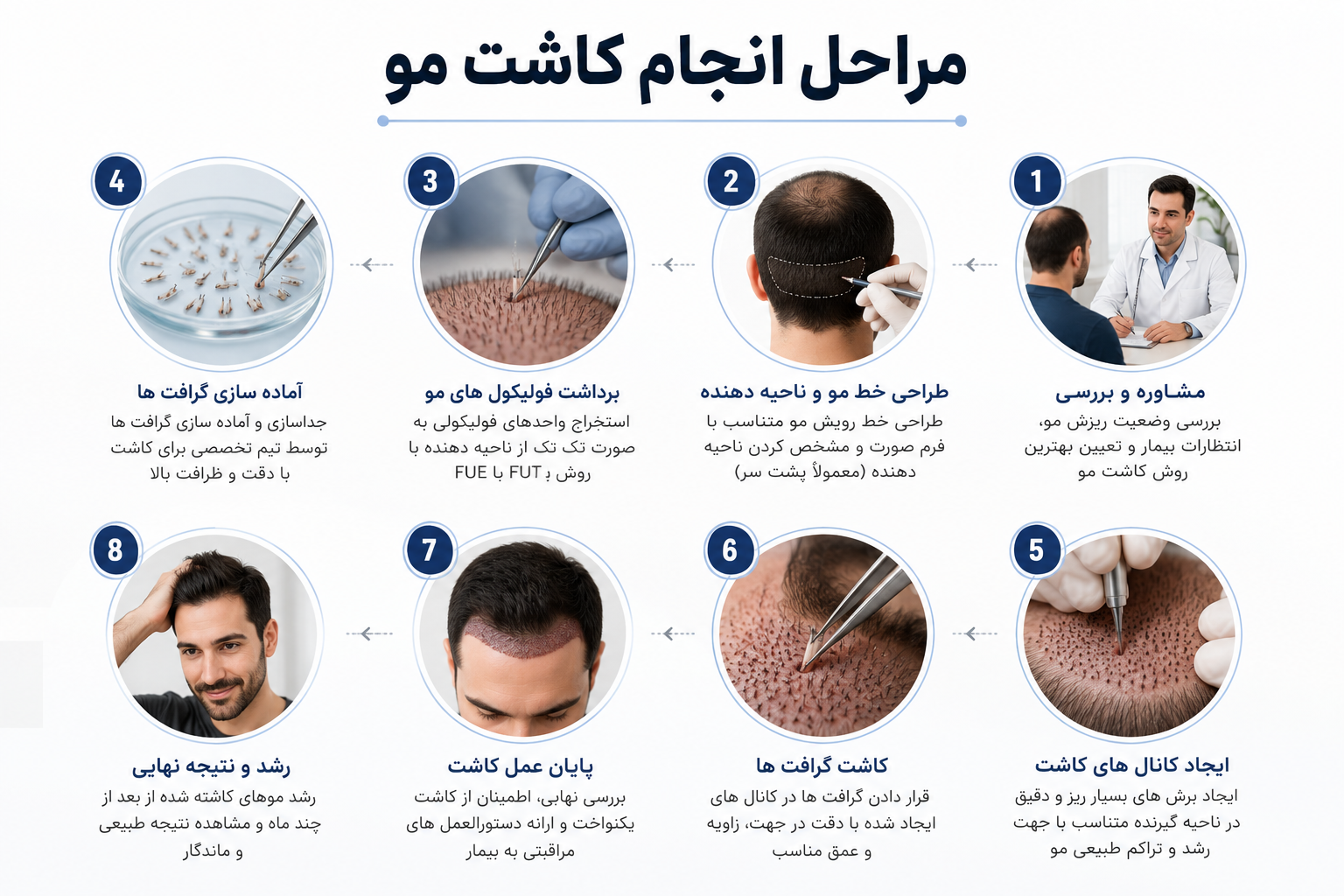 مراحل انجام کاشت مو