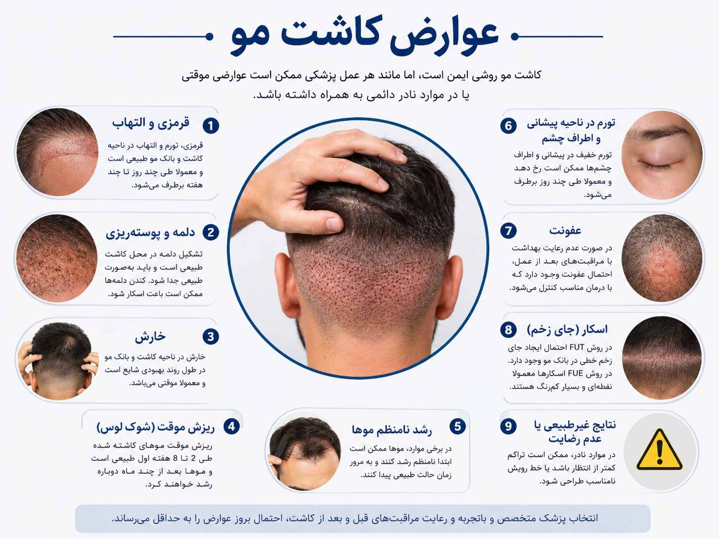 عوارض کاشت مو؛ بررسی کامل عوارض طبیعی و خطرات احتمالی پس از کاشت مو